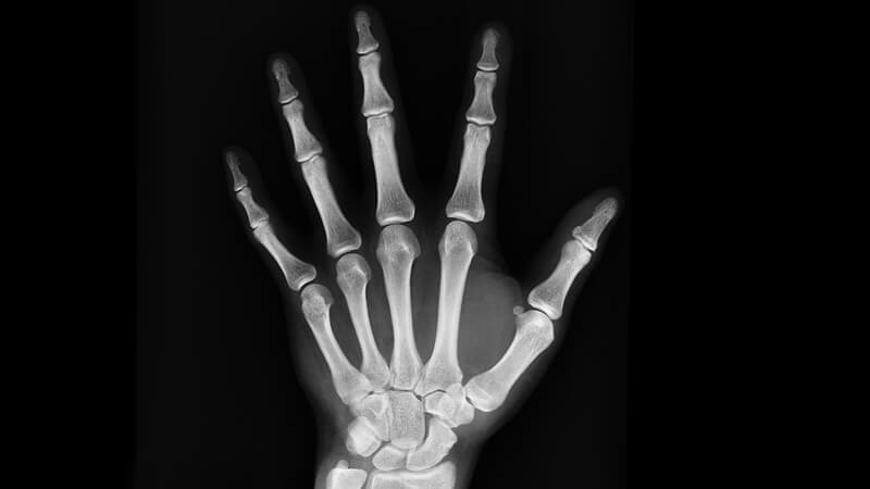 X ray of a human hand
